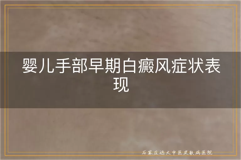 婴儿手部早期白癜风症状表现