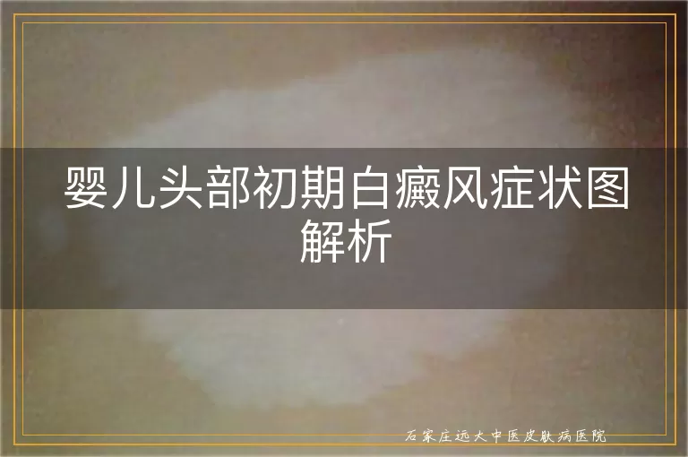婴儿头部初期白癜风症状图解析