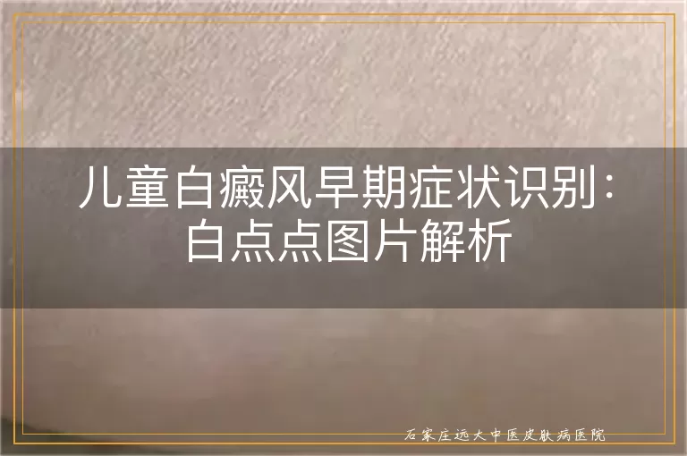 儿童白癜风早期症状识别：白点点图片解析
