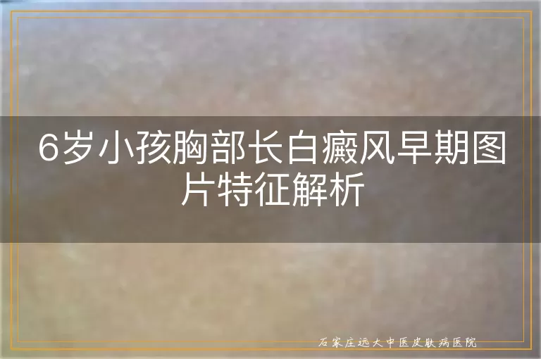 6岁小孩胸部长白癜风早期图片特征解析