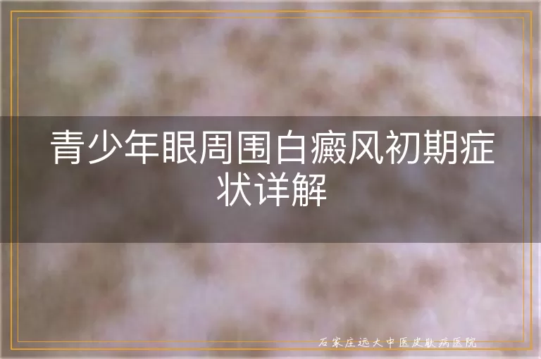 青少年眼周围白癜风初期症状详解