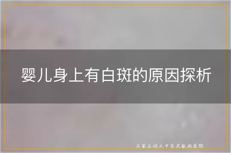 婴儿身上有白斑的原因探析