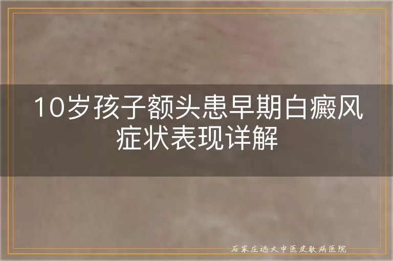 10岁孩子额头患早期白癜风症状表现详解