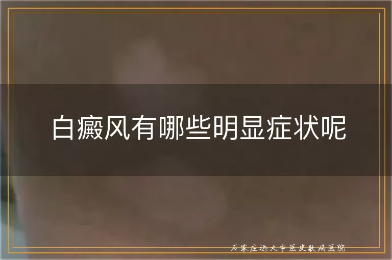 白癜风有哪些明显症状呢