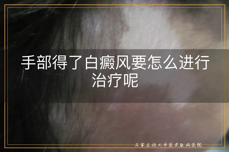 手部得了白癜风要怎么进行治疗呢