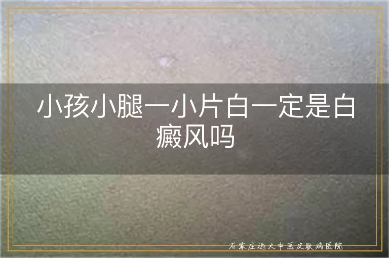 小孩小腿一小片白一定是白癜风吗