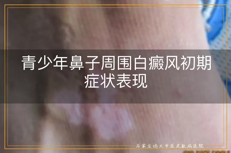 青少年鼻子周围白癜风初期症状表现
