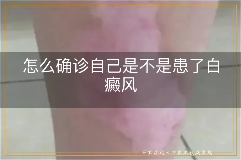 怎么确诊自己是不是患了白癜风