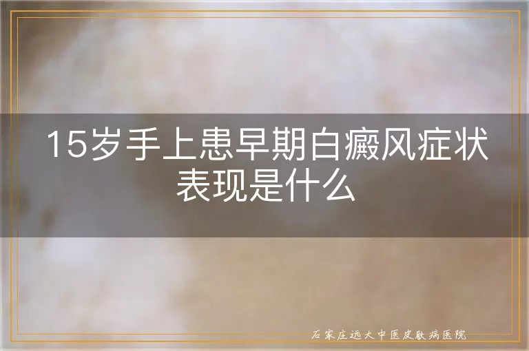 15岁手上患早期白癜风症状表现是什么