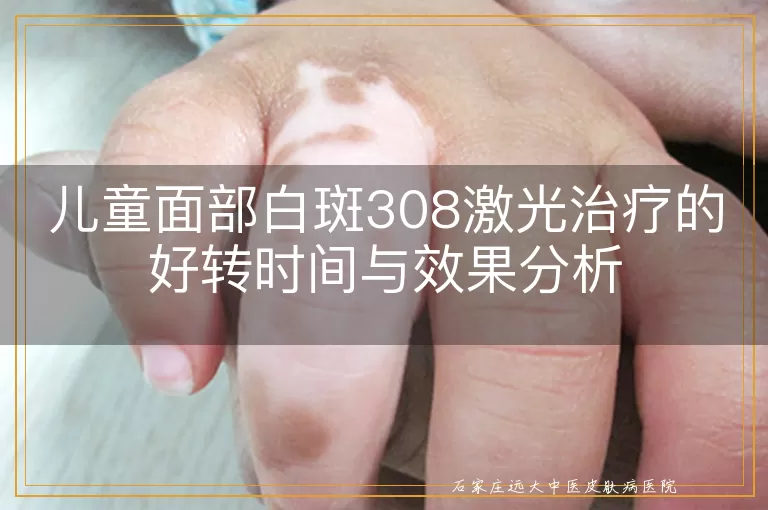 儿童面部白斑308激光治疗的好转时间与效果分析