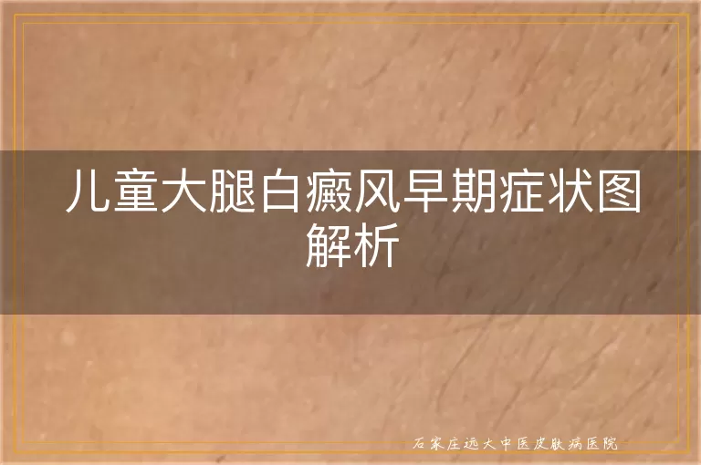 儿童大腿白癜风早期症状图解析