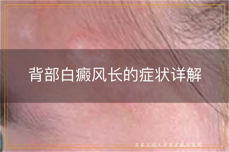 背部白癜风长的症状详解