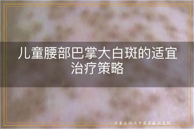 儿童腰部巴掌大白斑的适宜治疗策略