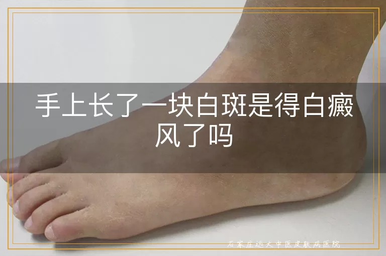 手上长了一块白斑是得白癜风了吗