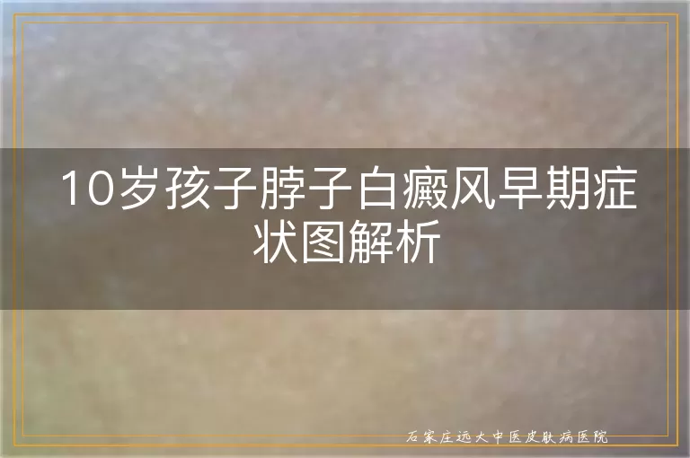10岁孩子脖子白癜风早期症状图解析