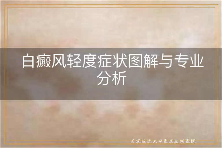 白癜风轻度症状图解与专业分析