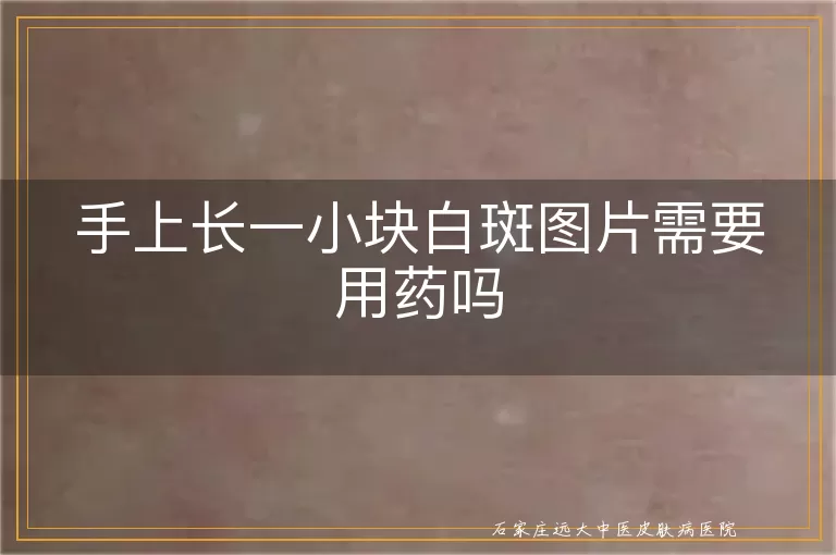 手上长一小块白斑图片需要用药吗