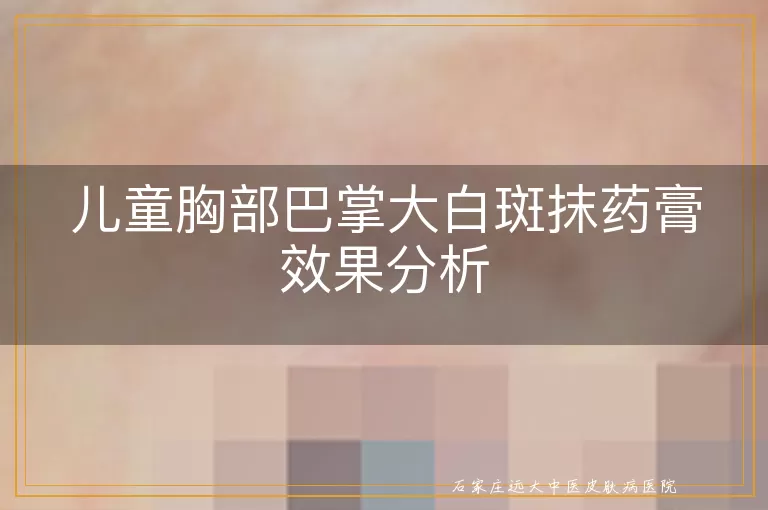 儿童胸部巴掌大白斑抹药膏效果分析