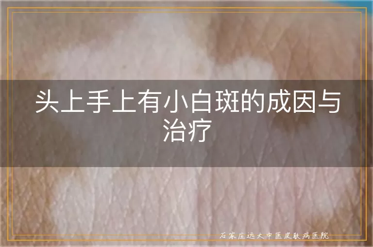 头上手上有小白斑的成因与治疗