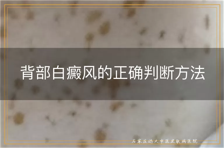 背部白癜风的正确判断方法