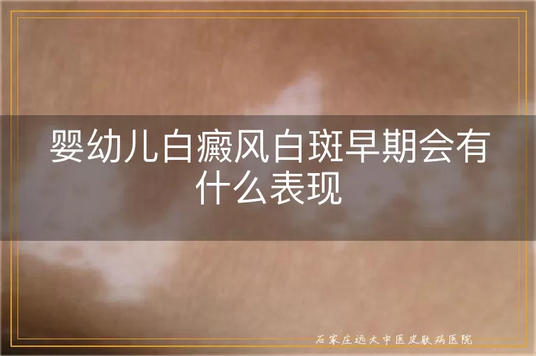 婴幼儿白癜风白斑早期会有什么表现