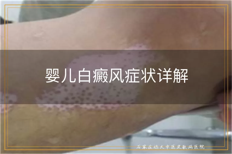 婴儿白癜风症状详解