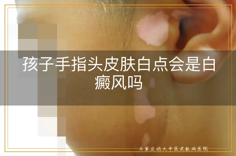 孩子手指头皮肤白点会是白癜风吗