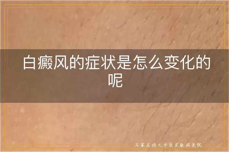 白癜风的症状是怎么变化的呢