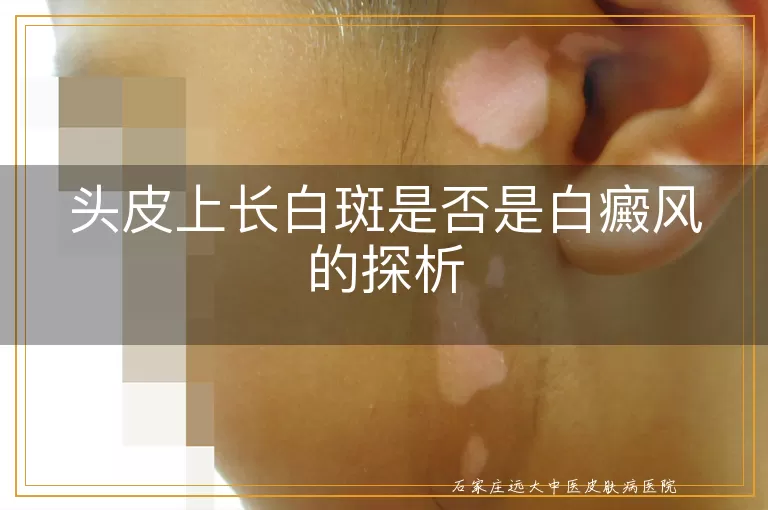 头皮上长白斑是否是白癜风的探析