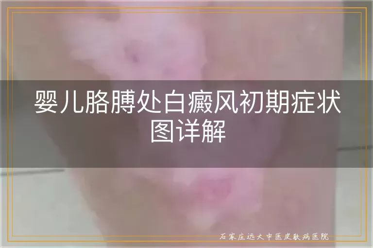 婴儿胳膊处白癜风初期症状图详解