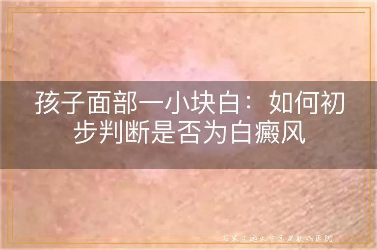 孩子面部一小块白：如何初步判断是否为白癜风