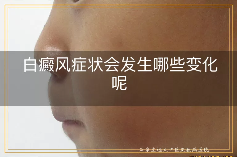白癜风症状会发生哪些变化呢