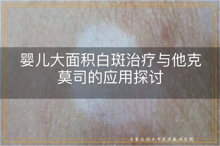 婴儿大面积白斑治疗与他克莫司的应用探讨