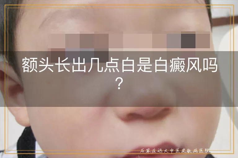 额头长出几点白是白癜风吗？