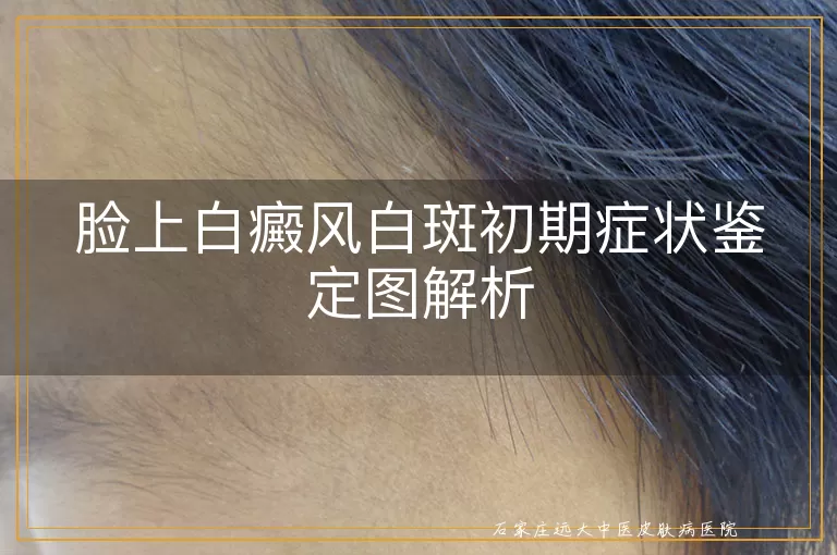 脸上白癜风白斑初期症状鉴定图解析