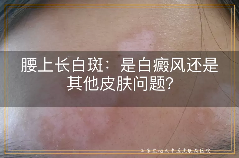 腰上长白斑：是白癜风还是其他皮肤问题？