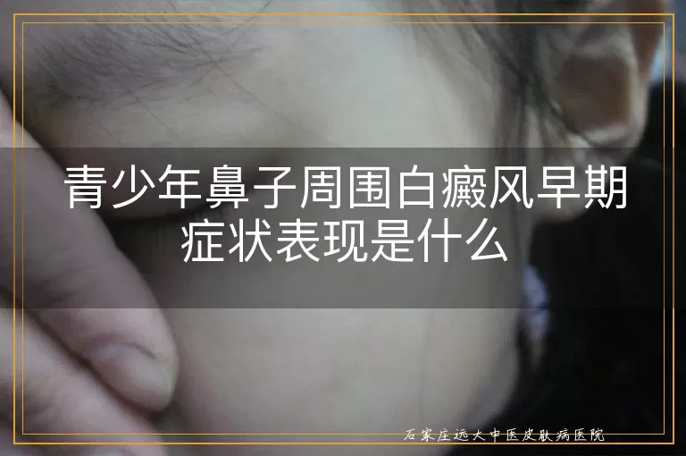 青少年鼻子周围白癜风早期症状表现是什么