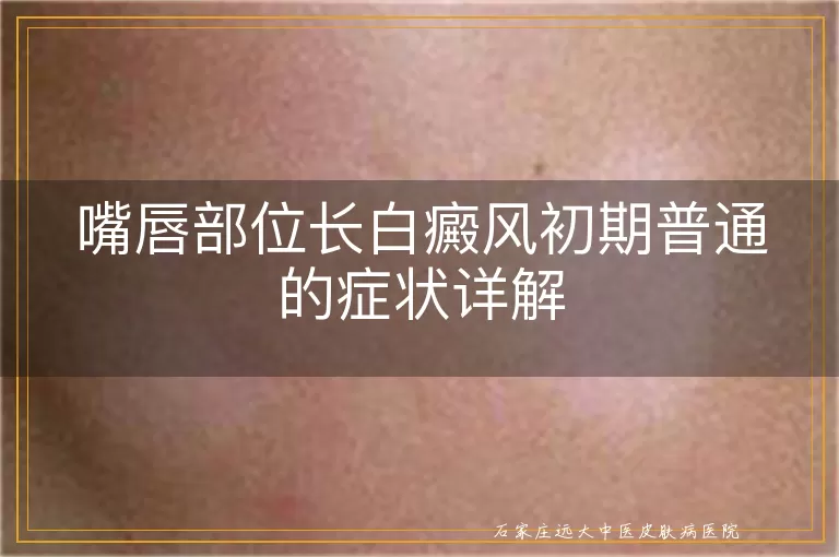 嘴唇部位长白癜风初期普通的症状详解