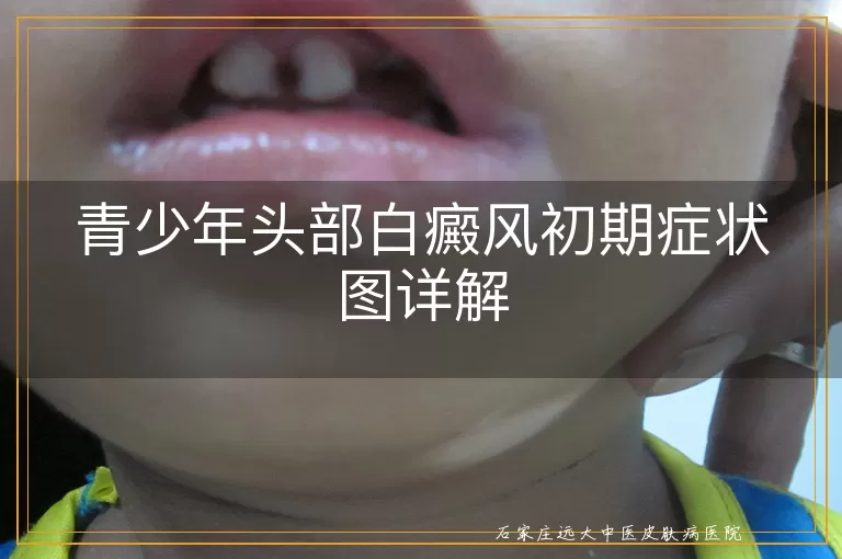 青少年头部白癜风初期症状图详解