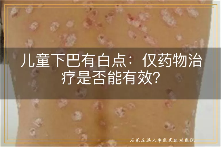 儿童下巴有白点：仅药物治疗是否能有效？
