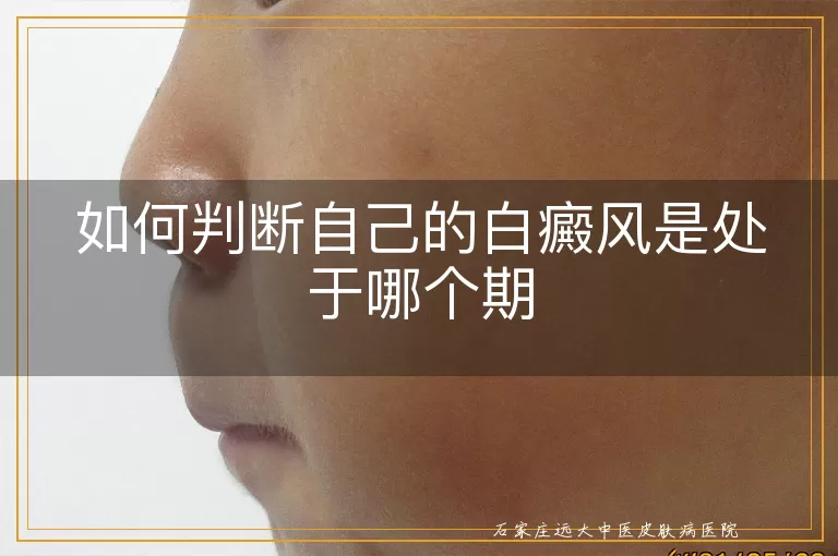 如何判断自己的白癜风是处于哪个期