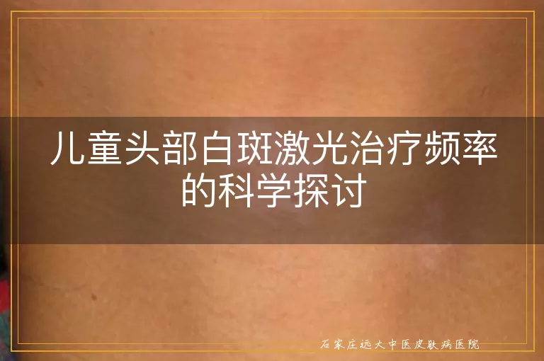 儿童头部白斑激光治疗频率的科学探讨