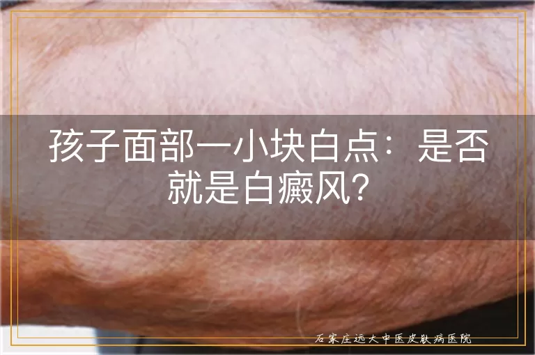 孩子面部一小块白点：是否就是白癜风？