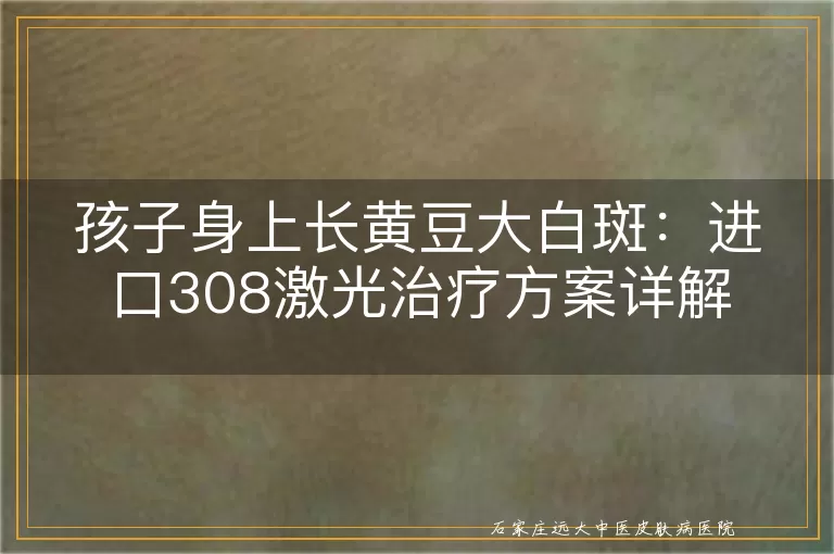孩子身上长黄豆大白斑：进口308激光治疗方案详解