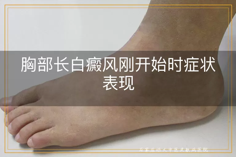 胸部长白癜风刚开始时症状表现