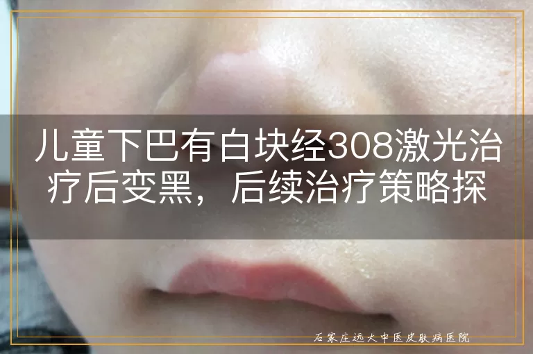 儿童下巴有白块经308激光治疗后变黑，后续治疗策略探讨