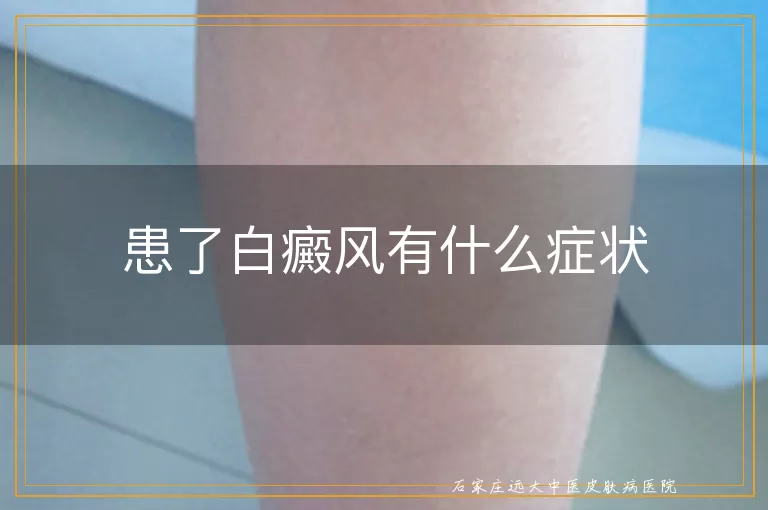 患了白癜风有什么症状