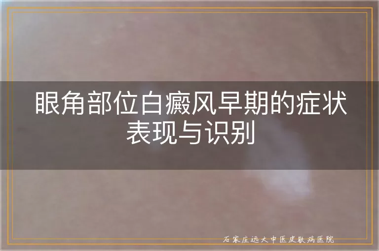眼角部位白癜风早期的症状表现与识别