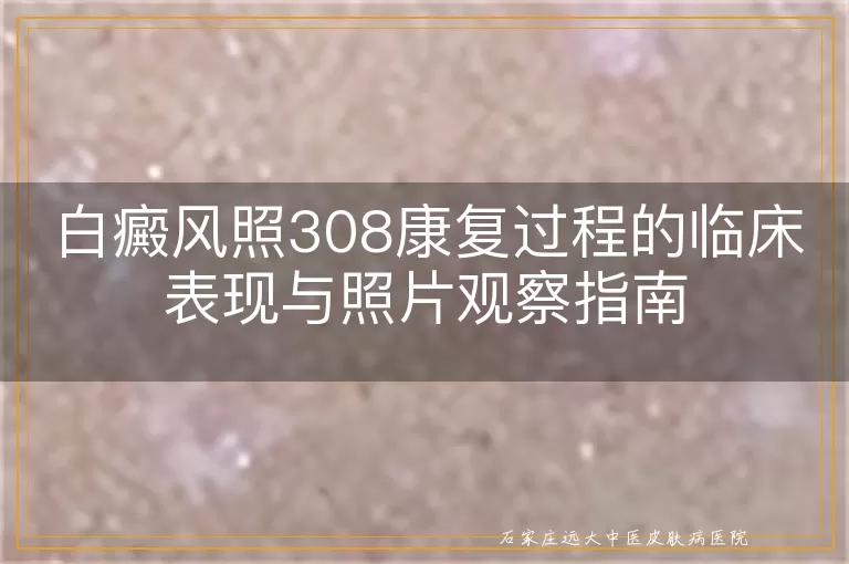 白癜风照308康复过程的临床表现与照片观察指南
