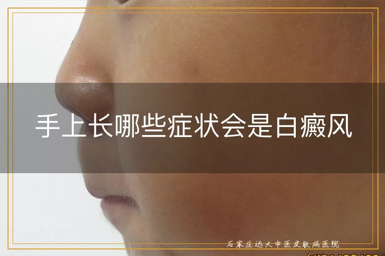 手上长哪些症状会是白癜风